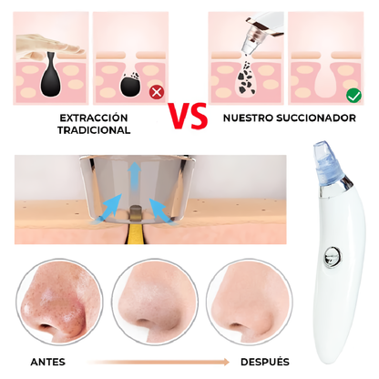 Punto Final Pro™ – Extractor de Puntos Negros y Espinillas